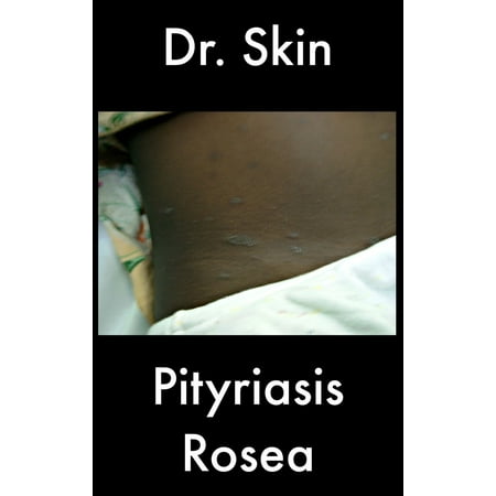 Pityriasis Rosea - eBook (Best Treatment For Pityriasis Rosea)