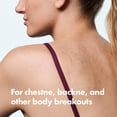 thumbnail image 4 of Mighty Patch Hero Cosmetics Body Patch– The XXL Hydrocolloid Patch for Bacne, Chestne, and Other Body Breakouts. Derm-Tested. Medical-Grade Hydrocolloid. Absorbs Pimple Gunk in 6-8 Hours. 4ct, 4 of 9