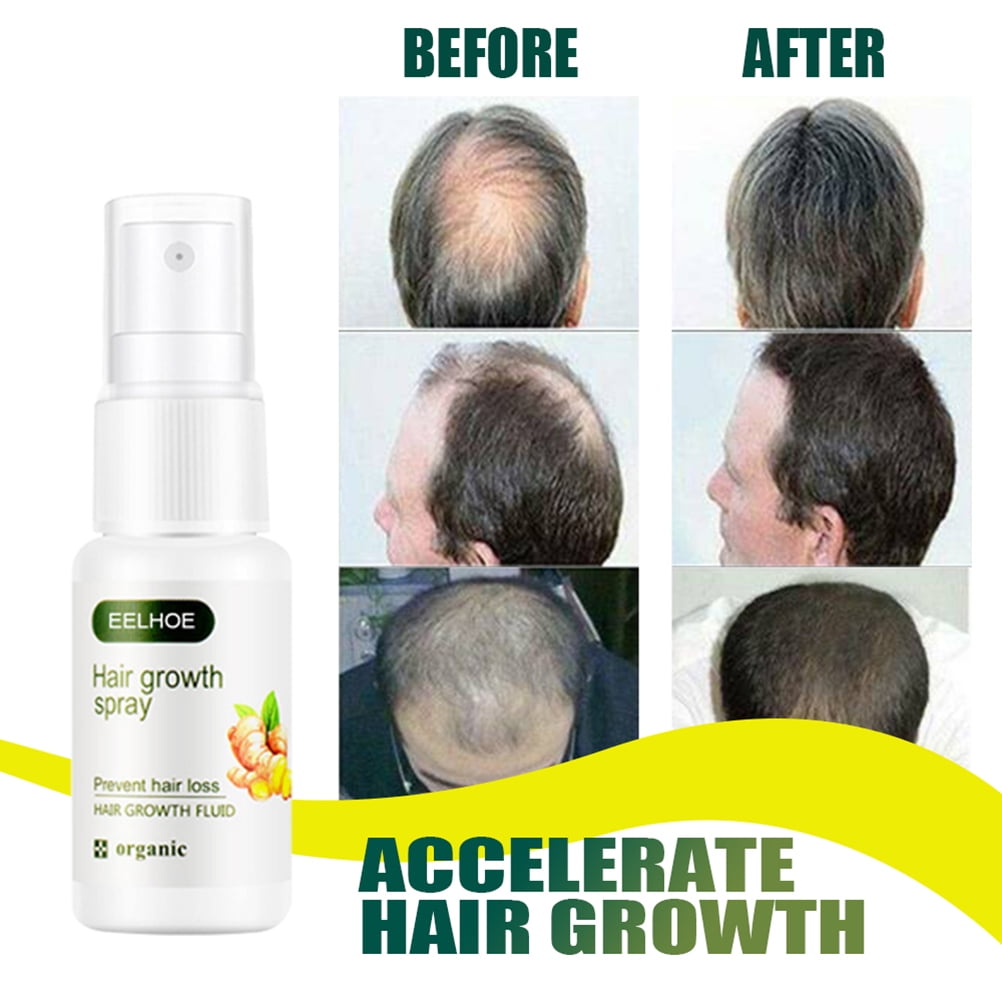 20ml Ginger Hair Growth Serum Anti Hair Loss Nourishing Hair Serum Hair  Care For Men And Women | Walmart Canada