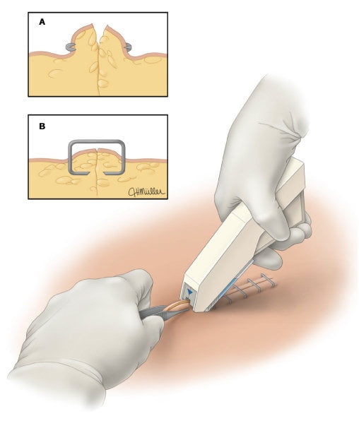 Sterile Skin Stapler