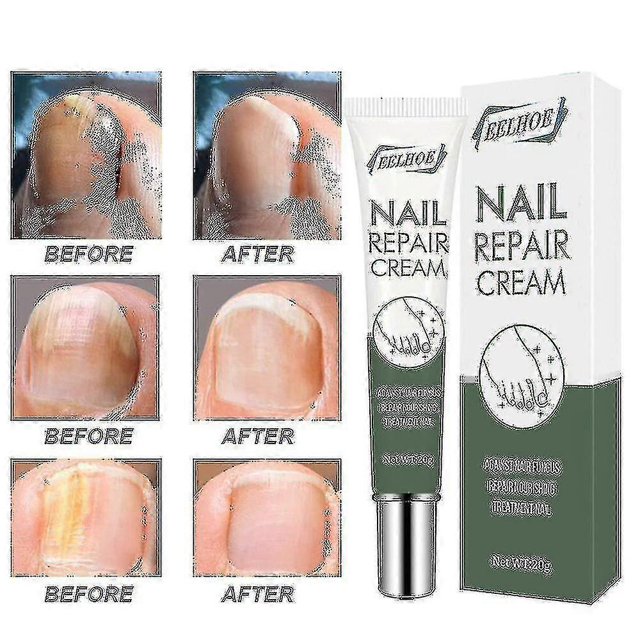 Crema para onicomicosis Eliminación rápida de onicomicosis Manicura Uñas