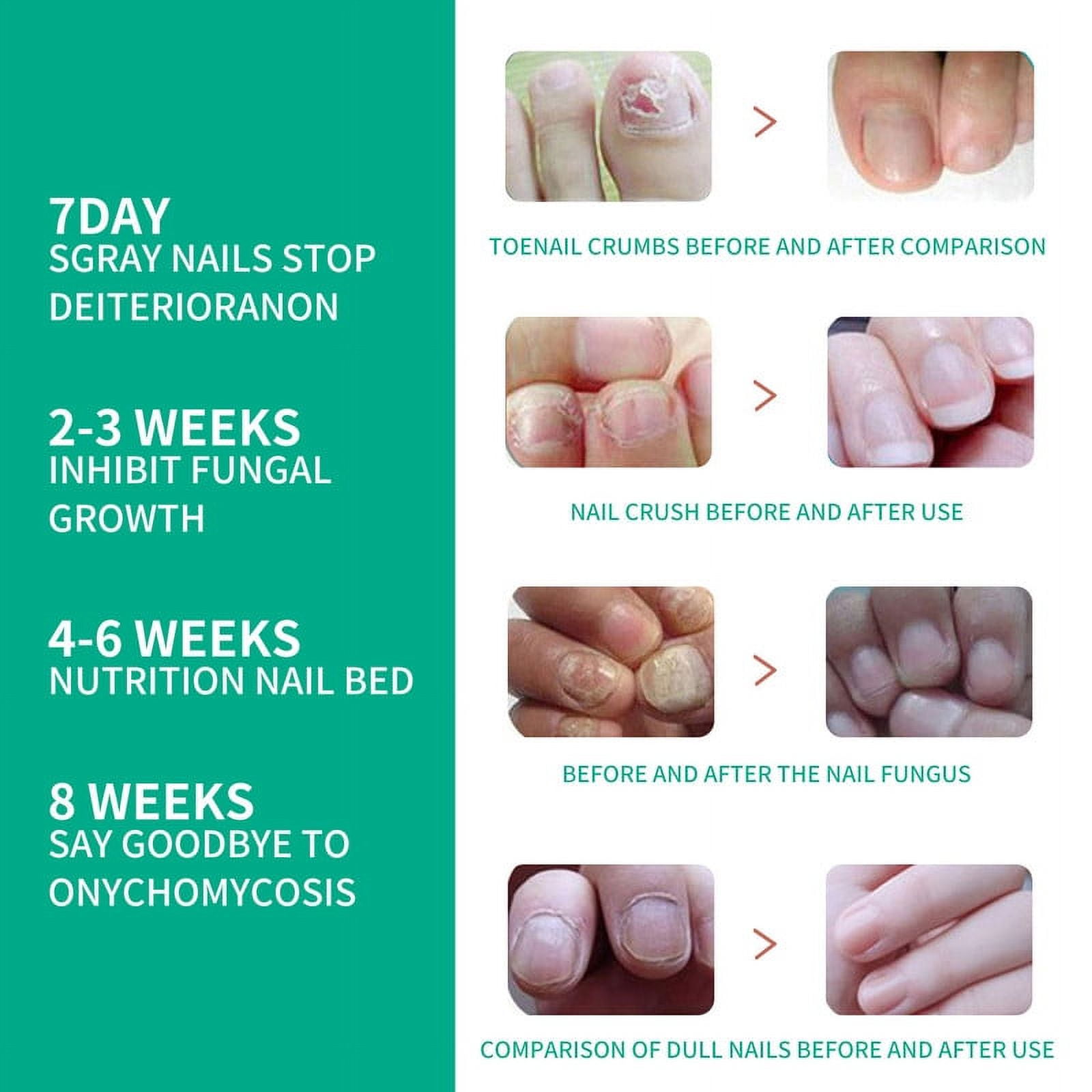 Kerassentials Toenail Treatment Oil, Kerasentials Toenail Nail Treatment for Damaged and Discolored Nails, Nail Treatment Drop For Fungal Infections(3 pcs)
