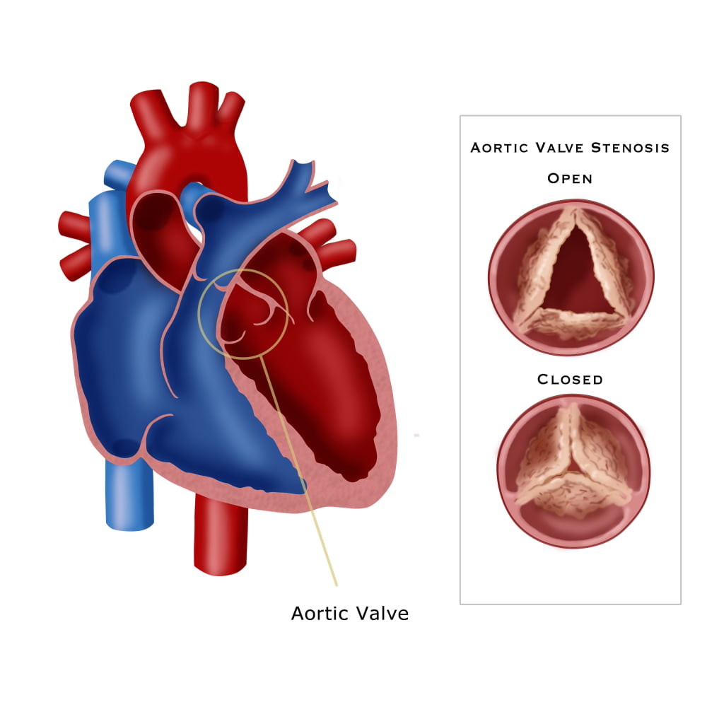 Aortic Valve Stenosis Poster Print By Monica Schroederscience Source