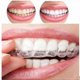 thumbnail image 2 of Set of 4 for Teeth Whitening/Gel Bleaching, Thermoforming, 2 of 3