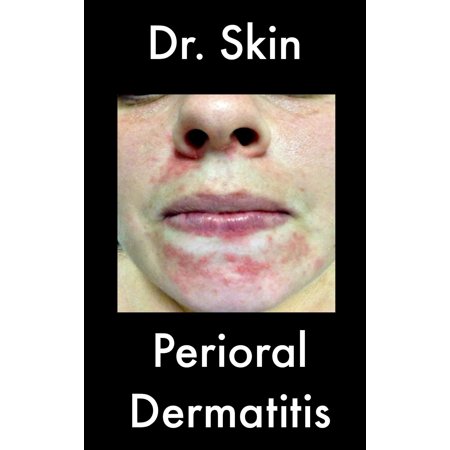 Perioral Dermatitis - eBook (Best Products For Perioral Dermatitis)