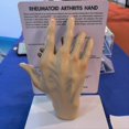 thumbnail image 4 of Modelo de Mano de Osteoartritis, Modelo de Patología de la Mano, Réplica de Anatomía y Fisiología , Modelo de Anatomía del Consultorio, 4 of 5