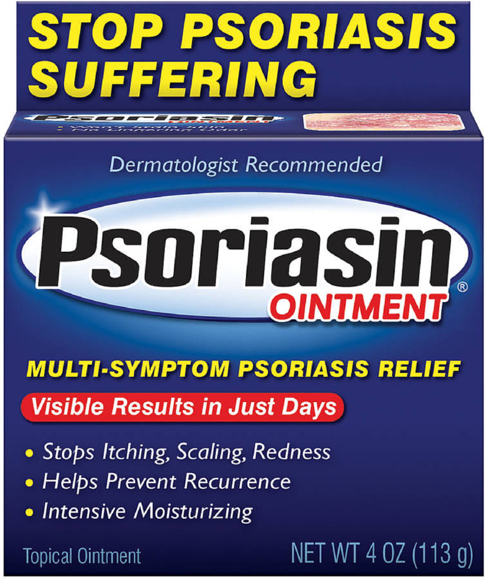 psoriasin ointment)