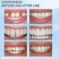 thumbnail image 3 of Denture Gum Resin False Teeth Temporary Tooth Repair False Teeth Denture Tooth Care Tool, 3 of 5