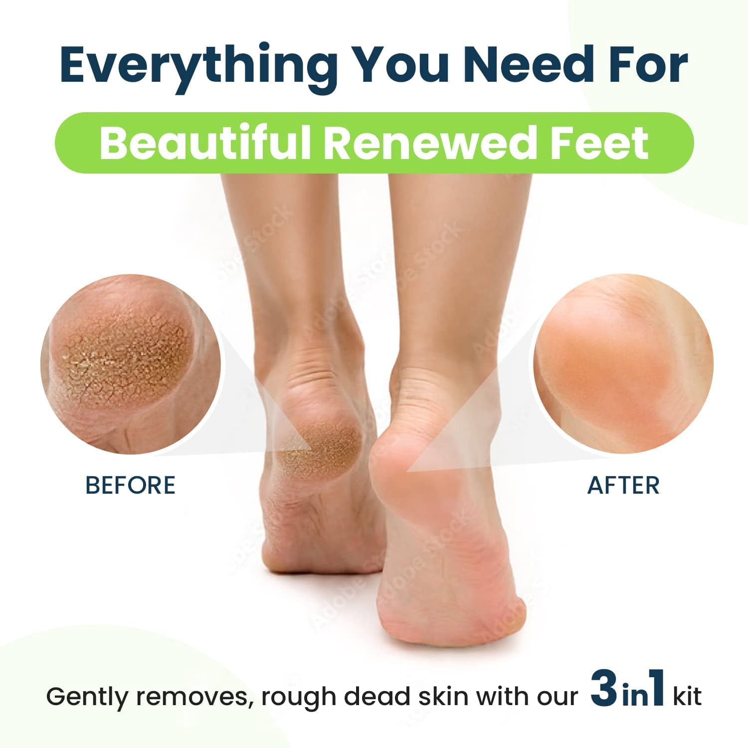 Foot Cure Callus Remover Gel - 2Pcs Strength Foot Callus Remover Gel with Pumice Stone for Dead Skin, Pedicure Spa Tools(16oz)