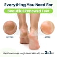 thumbnail image 6 of Foot Cure Callus Remover Gel - 2Pcs Strength Foot Callus Remover Gel with Pumice Stone for Dead Skin, Pedicure Spa Tools(16oz), 6 of 10