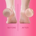 thumbnail image 2 of Cutikles Callus Remover Gel for Feet – Advanced Care Formula | Travel-Friendly Pack (1 Fl Oz), 2 of 7