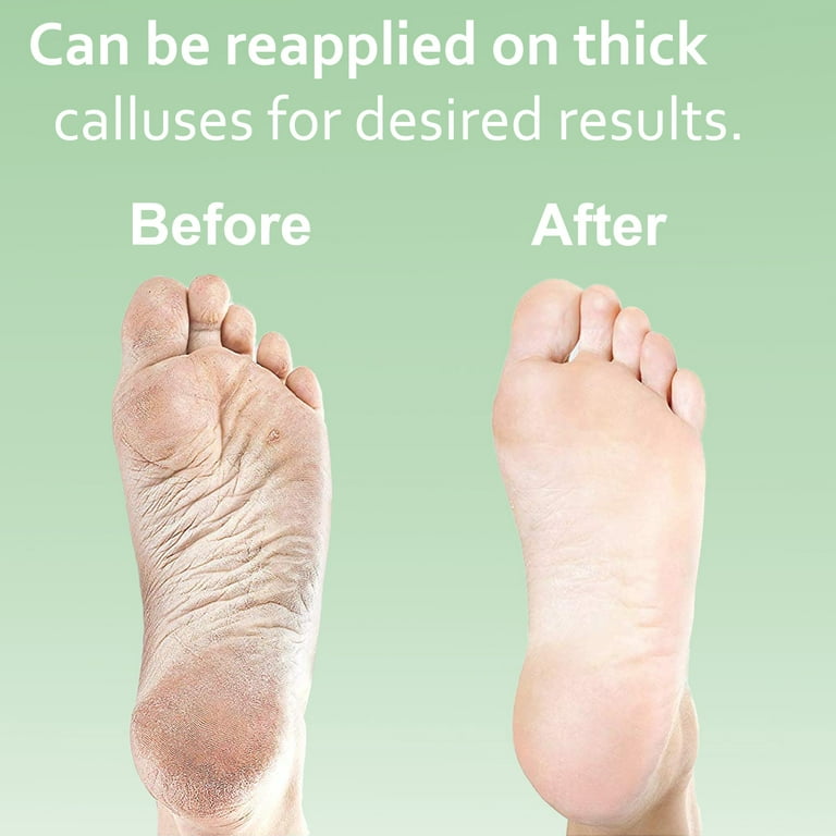 Callus Removal Extra Thick Foot Calluses