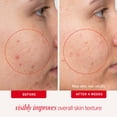 thumbnail image 3 of Almohadillas para el tratamiento del acné First Aid Beauty Maximum Strength 2% SA, 3 of 9