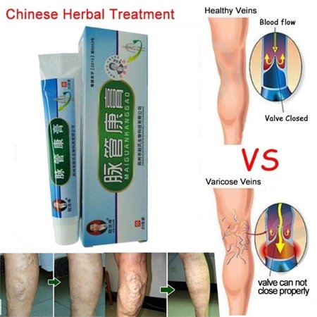 Bilges Itching Lumps Vasculitis Cream Medical Varicose Veins (Best Herbal Medicine For Varicose Veins)