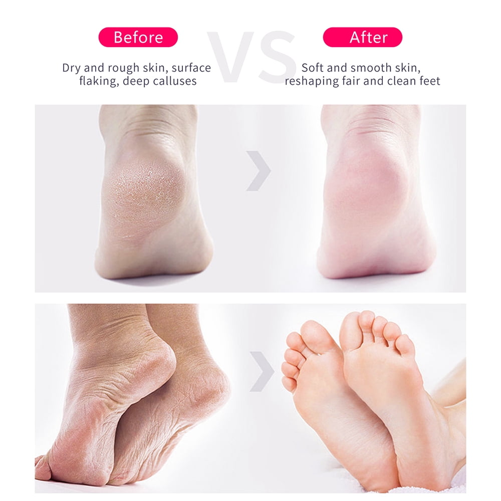Doxiry Electric Foot File, Electric Callus Remover for Feet Dead Skin & Calluses Removal, Pink