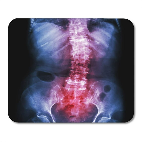 KDAGR Spondylosis and Scoliosis Film X Ray Lumbar Sacrum Spine Show Crooked Old Patient Healthcare Mousepad Mouse Pad Mouse Mat 9x10 inch