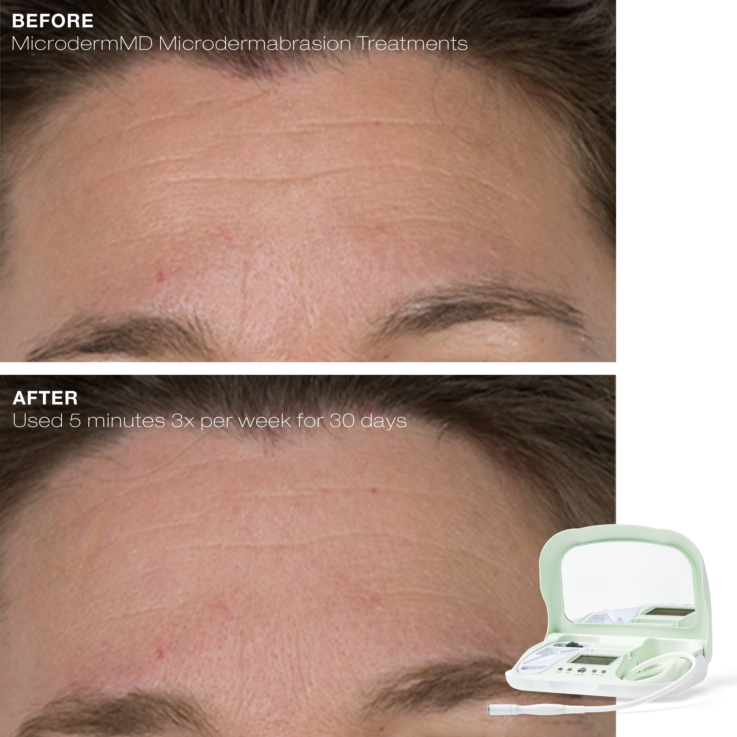 UltradermMD by Trophy Skin Microdermabrasion System $139 ($349