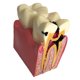 thumbnail image 5 of Modelo De Herramienta De Enseñanza Cariados Dispensión Gingival Modelo 2 DYNWAVEMX Molde de estudio de compactación de caries, 5 of 5
