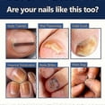 thumbnail image 3 of Nail Fungus Treatment Cream, 20g Toenail Fungus Treatment Cream, Strong Anti-Fungal Toenail Cream, Fungal Nail Treatment Cream, 3 of 5