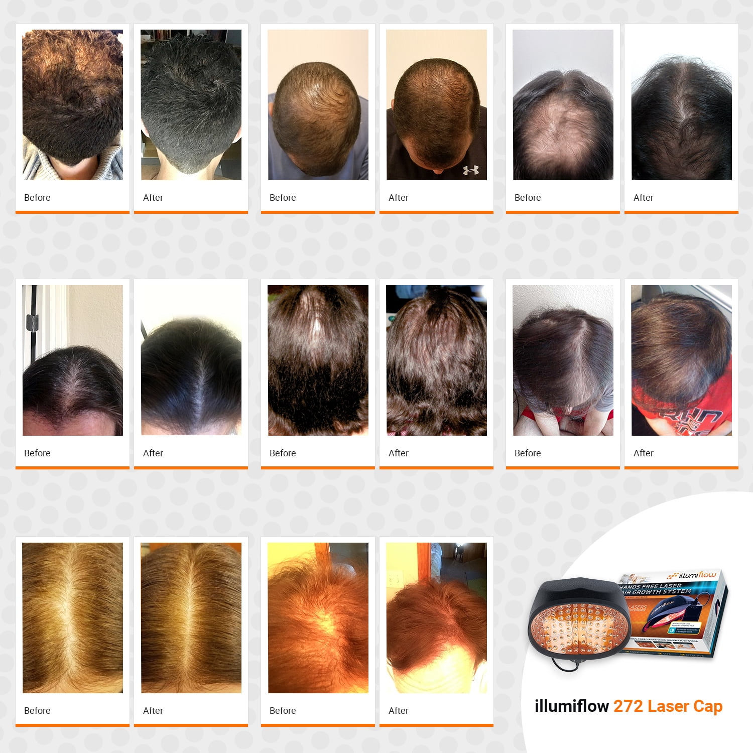 iRestore Laser Hair Growth System  Hair Loss Treatment for Men and Women Hair  growth helmet  Amazonin Beauty