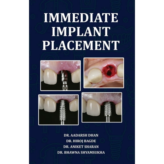 Immediate Implant Placement, (Paperback)