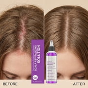Scalp Care,Scalp Exfoliator,Scalp Revitalizing Solution – Gently Removes Buildup, Excess Sebum And Residues, Gently Exfoliates Scalp, Soothes Scalp, Deeply Cleanses Scalp(100ml/3.38fl.oz)