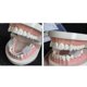 thumbnail image 4 of 2 protectores bucales para bruxismo, férula para dormir, aparatos dentales para apretar los dientes, entrenador de alineación, ayuda para dormir, protector dental, herramientas_FC31, 4 of 5
