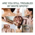 thumbnail image 2 of 30g White Spots Treatments Cream Improve Skin Pigmentation Cream for Body Skin Repair, 2 of 5