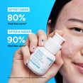 thumbnail image 3 of Serum innisfree, tratamiento suave con retinol salicílico para el acné, 50 ml, 3 of 9
