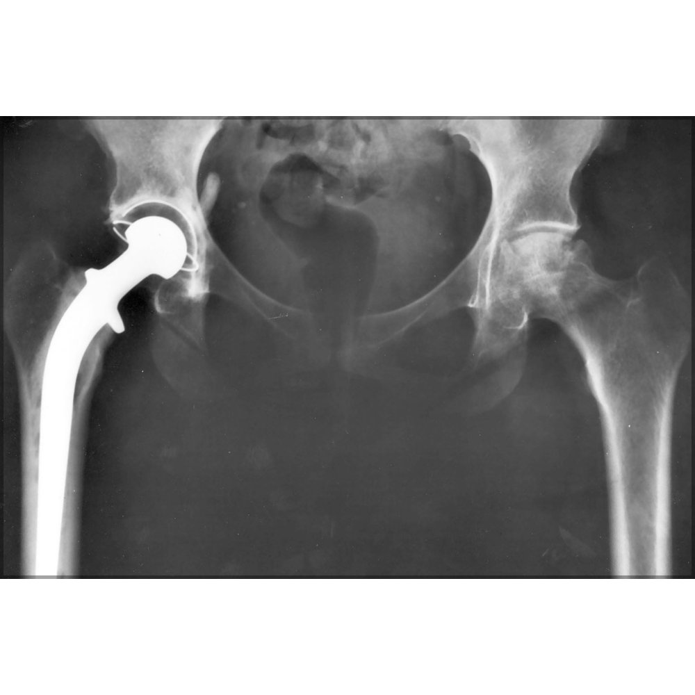 24"x36" Gallery Poster, artificial hip replacement