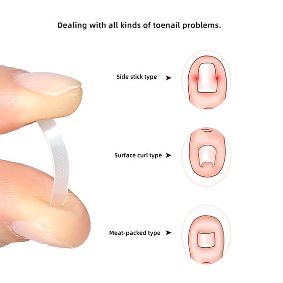 XIRQI 10pcs Ingrown Toe Nail Treatment Ingrown Toenail Correction Tool Elastic Patch Sticker Straightening Clip Brace Pedicure Tools