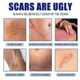 thumbnail image 5 of Acnes Scars Removal Cream Effectiveness Non-irritating Cream For Face, 5 of 5