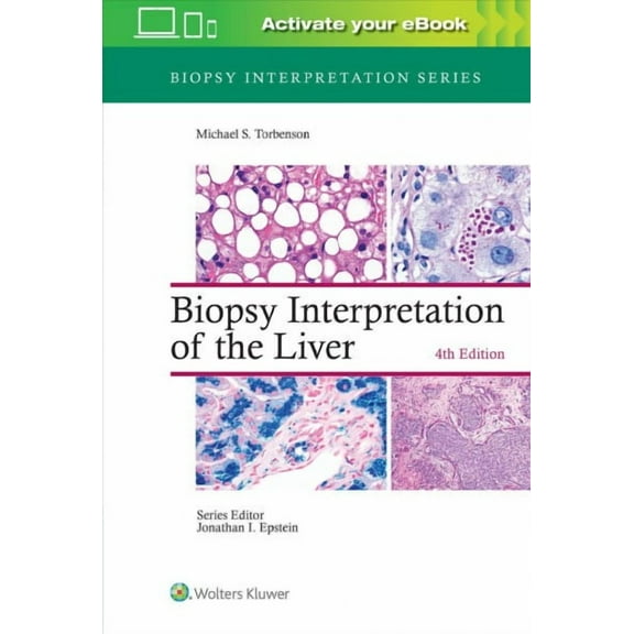 Biopsy Interpretation: Biopsy Interpretation of the Liver (Hardcover)