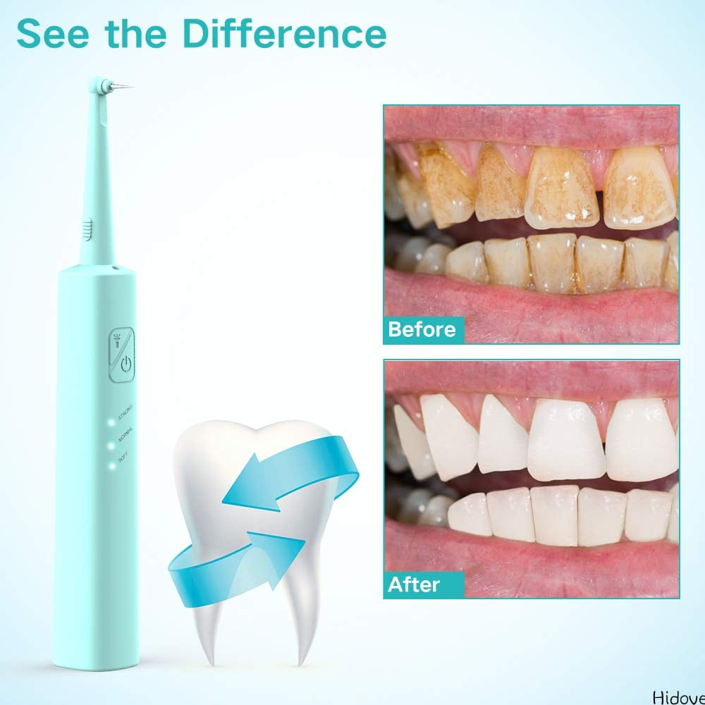 before and after dental calculus remover before and after dental calculus remover