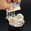 Dental Implant Disease Teeth Model With Restoration Bridge Tooth Dentist For Medical Science Dental Disease Teaching Study;Dental Implant Disease Teeth Model With Restoration Bridge Tooth Dentist
