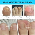thumbnail image 5 of 100 Pcs Ingrown Toenail Corrector Strips with Toenail Lifter,Ingrown Toenail Correction Brace Toenail Correction Clip Toenail Straightening Recover Curved Toenail Corrector for Women Men Foot Care, 5 of 7