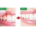 thumbnail image 2 of Aerosol dental instantáneo para aliviar el dolor de dientes, 11 Feliz Sencillez, 2 of 5