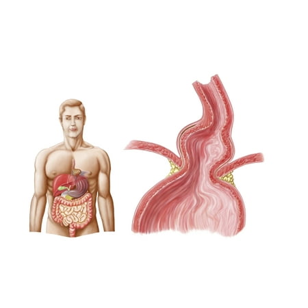 Medical ilustration of a hiatal hernia in the upper part of the stomach into the thorax Poster