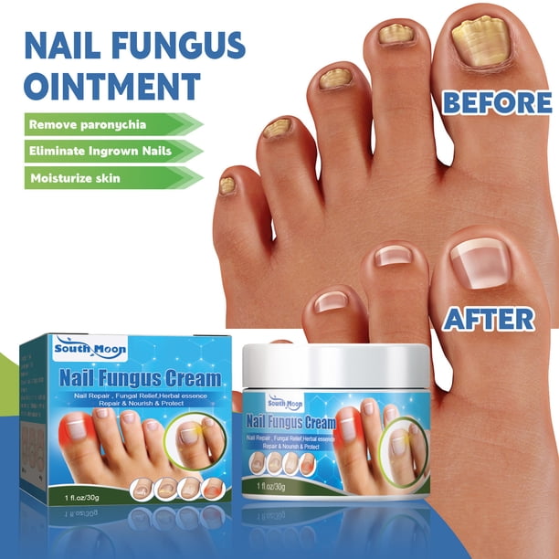 YANXIAO Toenail Fungus Care, FastActing Nail Care Paste For Fungus