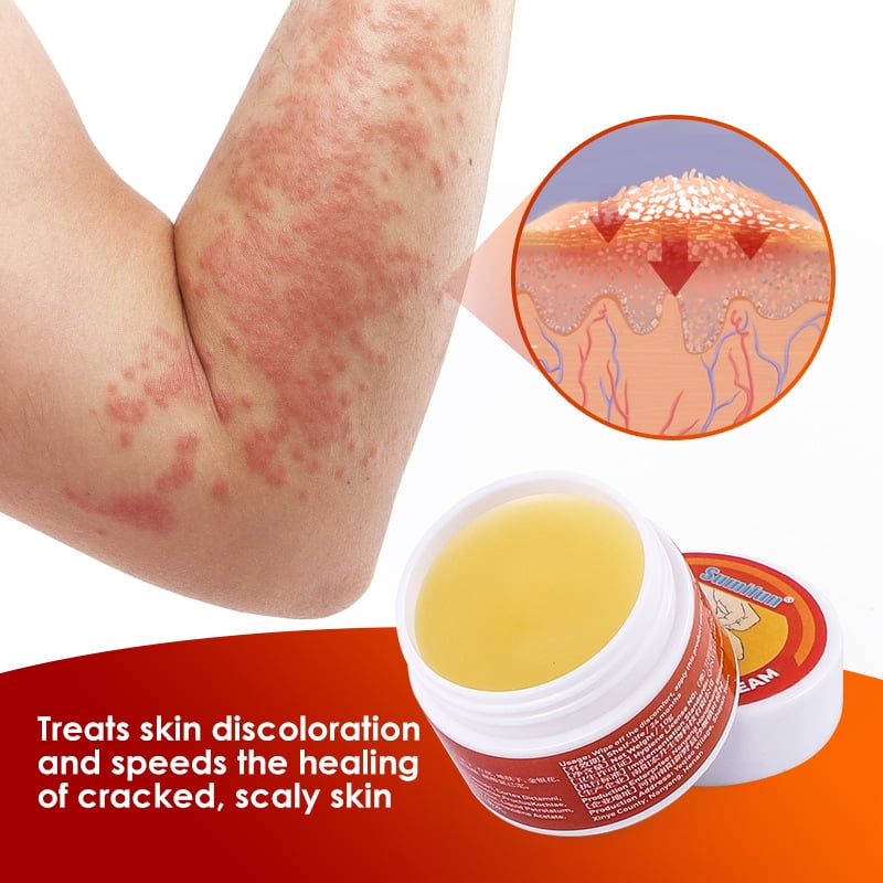Skin Allergy Itching Fungal Anti Ringworm Seborrheic Dermatitis