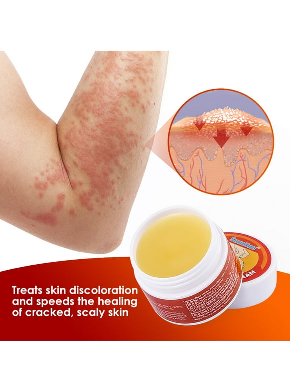 Ringworm in First Aid