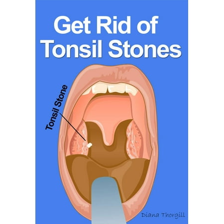 Get Rid of Tonsil Stones: Causes, Symptoms, Treatment, Removal and Other Remedies - (Best Way To Prevent Tonsil Stones)