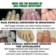 thumbnail image 5 of 7 Days Nail Fungus Treatment All Natural Formula Gingers Nail Toenail Care, 5 of 5