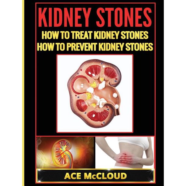 Kidney Stone Treatment & Prevention Guide with All Kidney Stones How