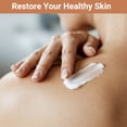 thumbnail image 2 of Urticaria Cream for Hives Relief - Fast Acting Anti Itch Treatment with All Natural Herbal Formula for Skin Allergic Rashes, Redness, Swelling 3.53 oz, 2 of 8