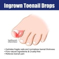 thumbnail image 4 of Ingrown Toenail Drops Treatment - Ingrown Toenail Pain Reliever and Softener Kit for Easy Trimming, Nail Care and Treatments, 4 of 8
