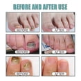 thumbnail image 3 of 1pc Fungal Nail Treatment Liquid Nail Repair Moisturizing Anti-bag Nursing Liqui, 3 of 5