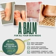 thumbnail image 3 of Bálsamo KESMEDIK, aceite de árbol de té MaxTherapy, para aliviar la picazón en la piel, paquete de 2, 3 of 7