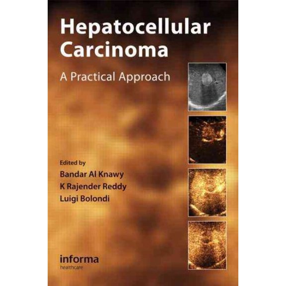Pre-Owned Hepatocellular Carcinoma : A Practical Approach