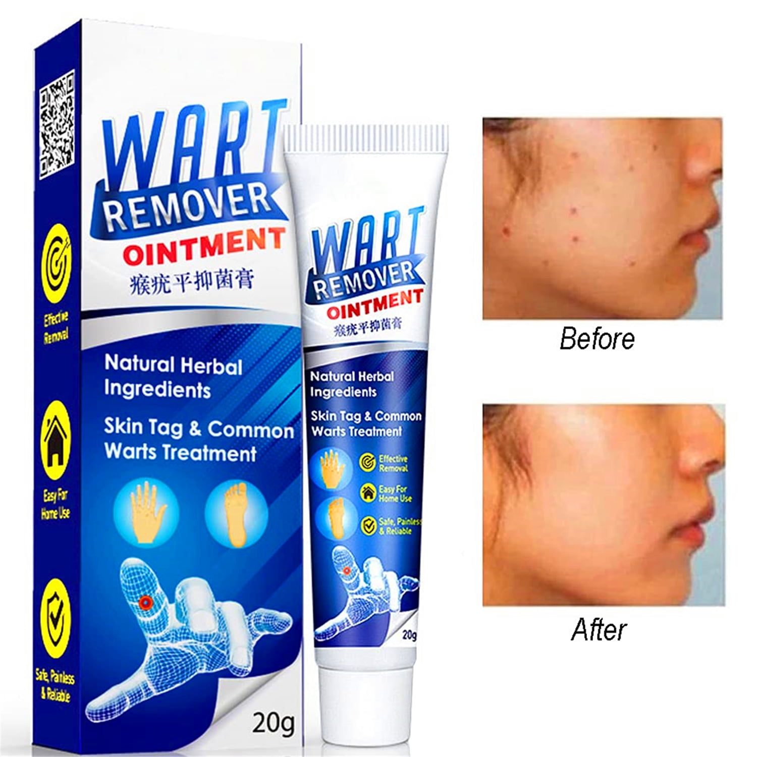 Wart Removal Cream Instant Blemish Removal Gel Effective And Safe Common Wart For Body Skin Tag